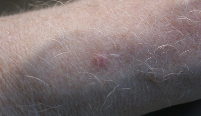 This spot on left arm (just above wrist) was a nasty blue colour and weeping---what hospitals cut out on a daily basis. Dried up and went back to mild red colour (and now slowly going away) after giving up heavy wheat bread addiction. Probably on a meridian. Also pain on bottom of left foot, intestine area in kinesiology.
